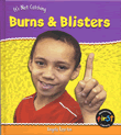 BURNS AND BLISTERS