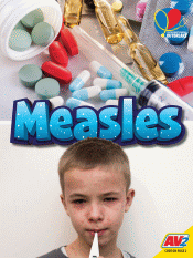 MEASLES
